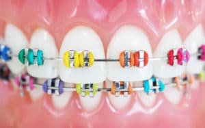 Braces Colors Valeri Orthodontics