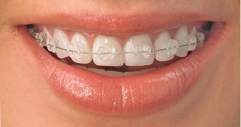 Clear Braces Valeri Orthodontics