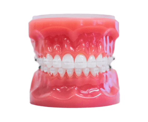 Clear Braces – Elk Grove Village & Hanover Park - Invisible Orthodontic  Braces In IL