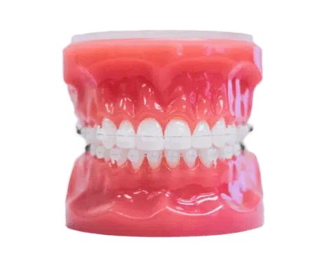 Clear Braces