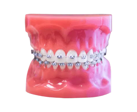 Metal Braces Kenosha WI